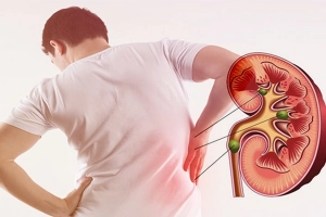 Bị sỏi thận kiêng ăn gì?