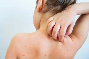 Bị sốt xuất huyết có kiêng gió không?