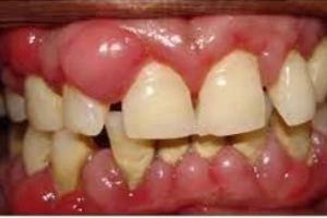 Bị sưng lợi phải làm sao?