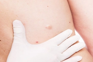 Bị u bã đậu và cách chữa trị hiệu quả