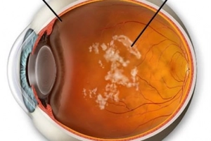 Bị vẩn đục dịch kính có tự hết không?