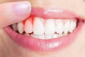 Bị viêm chân răng uống thuốc gì?