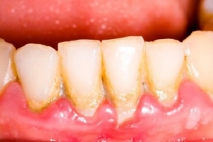 Bị viêm lợi uống thuốc gì?