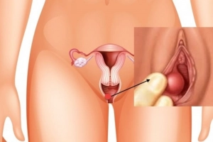 Bị viêm tuyến bartholin có tự khỏi?