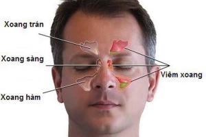 Bị viêm xoang sàng uống thuốc gì?