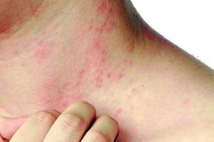 Biểu hiện da của người bị tiểu đường