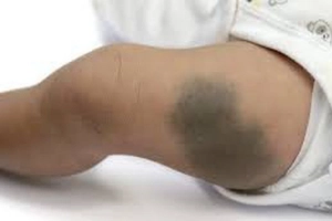 Bớt giảm sắc tố là gì?