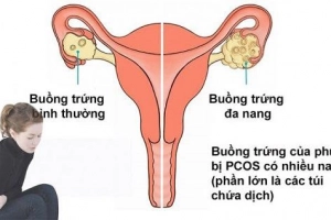 Các biến chứng của buồng trứng đa nang
