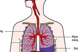 Các biến chứng của lao hạch