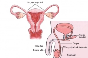 Các biện pháp ngừa thai vĩnh viễn