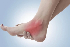 Các biểu hiện của bệnh gút bạn cần chú ý