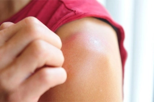 Các cách chữa cháy nắng an toàn
