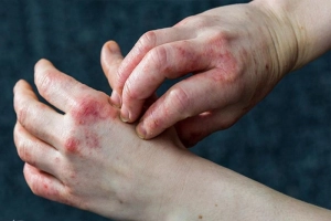 Các cách chữa eczema hiệu quả