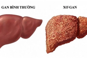 Các cách chữa xơ gan thường dùng