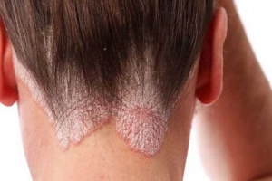 Các cách điều trị bệnh vảy nến