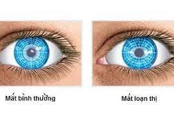 Các cách giảm loạn thị