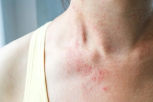Các cách giảm ngứa khi bị viêm da cơ địa