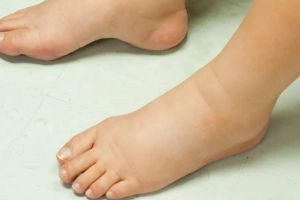 Các cách giảm phù chân