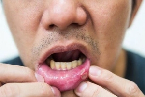 Các cách trị lở miệng nhanh nhất tại nhà