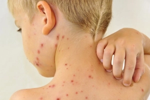 Các cây thuốc nam chữa bệnh thuỷ đậu