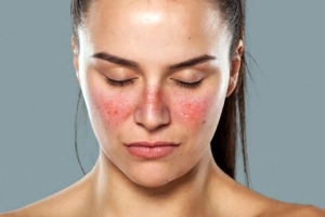 Các dấu hiệu điển hình của bệnh lupus ban đỏ