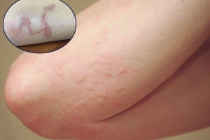Các dấu hiệu nhiễm sán chó