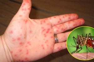 Các điểm cần lưu ý trong phác đồ điều trị sốt xuất huyết Dengue