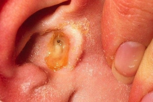 Các giai đoạn của viêm tai giữa ở trẻ em
