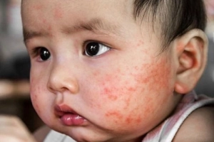 Các loại chàm ở trẻ sơ sinh