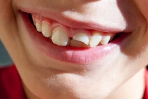 Các loại chấn thương răng cửa có thể gặp