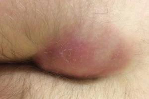 Các nguyên nhân khiến hậu môn bị sưng