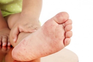 Các nốt mụn nước của bệnh chân tay miệng mọc ở đâu trước?
