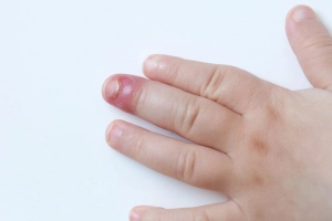 Các thể chín mé thường gặp