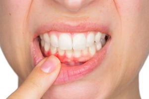 Các thuốc trị viêm nướu răng