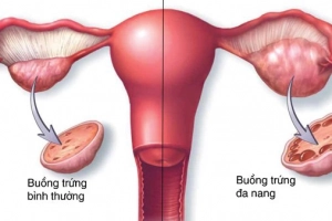 Các tiêu chuẩn chẩn đoán buồng trứng đa nang