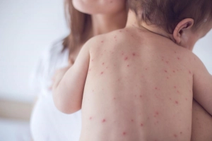 Các triệu chứng thủy đậu khi mới khởi phát