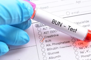 Các trường hợp cần xét nghiệm ure trong máu