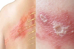 Các vấn đề về da thường gặp ở người lớn: Bệnh zona, nổi mề đay và hơn thế nữa