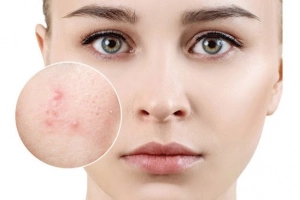 Cách chăm sóc da dầu mụn lỗ chân lông to