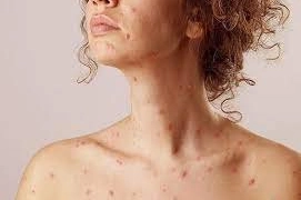 Cách chăm sóc da khi bị thuỷ đậu
