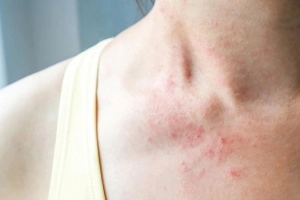 Cách chữa bệnh viêm da dị ứng