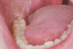 Cách chữa đau răng số 8 (răng khôn)