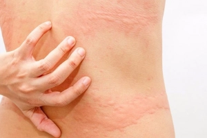 Cách chữa dị ứng hải sản nhanh nhất