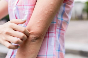 Cách chữa dị ứng nổi mề đay tại nhà