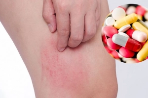 Cách chữa dị ứng thuốc kháng sinh tại nhà