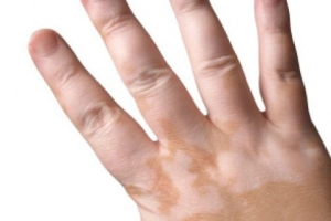 Cách chữa lang ben ở trẻ em