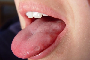 Cách chữa nhiệt lưỡi hiệu quả nhanh