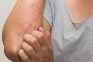 Cách chữa nổi mề đay hiệu quả