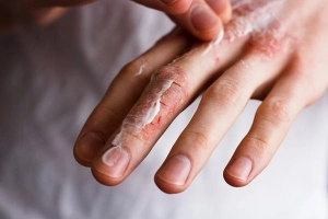 CÁCH CHỮA NỨT ĐẦU NGÓN TAY