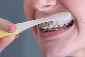 Cách đánh răng đúng cách khi niềng răng